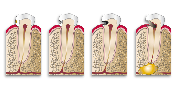 stages of tooth cavities