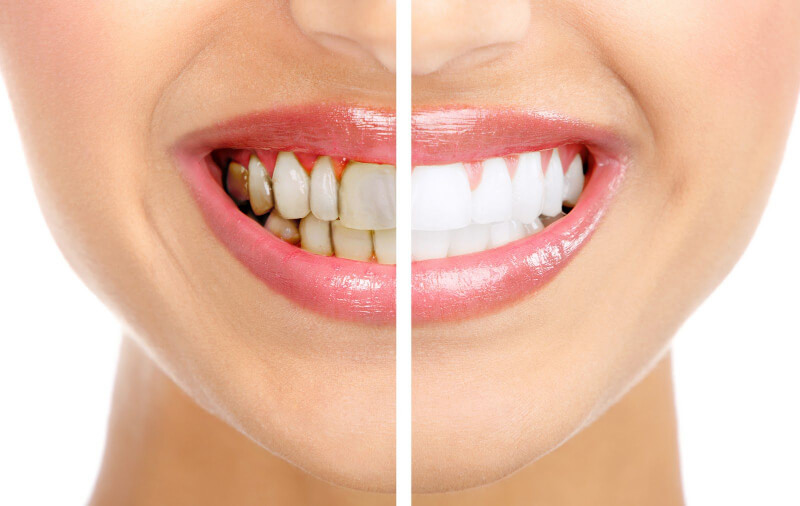  Quy trình và phương pháp tẩy trắng răng tại phòng nha và tại nhà 